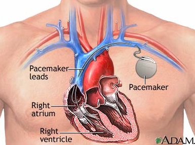 pacemaker